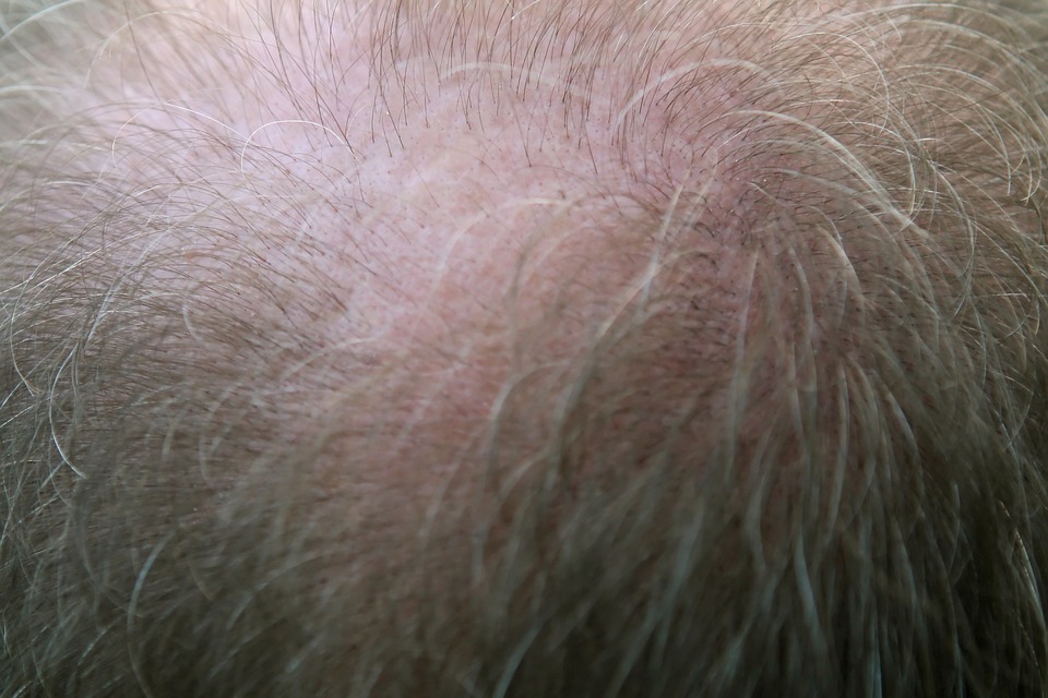 alopecia-capelli